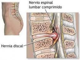 Hernia discal lumbar