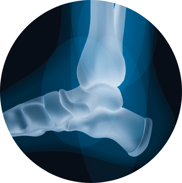 Tratamiento patología del pie. Juanetes y Neuroma de Morton