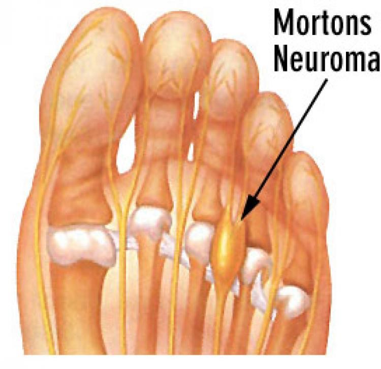 Neuroma de Morton