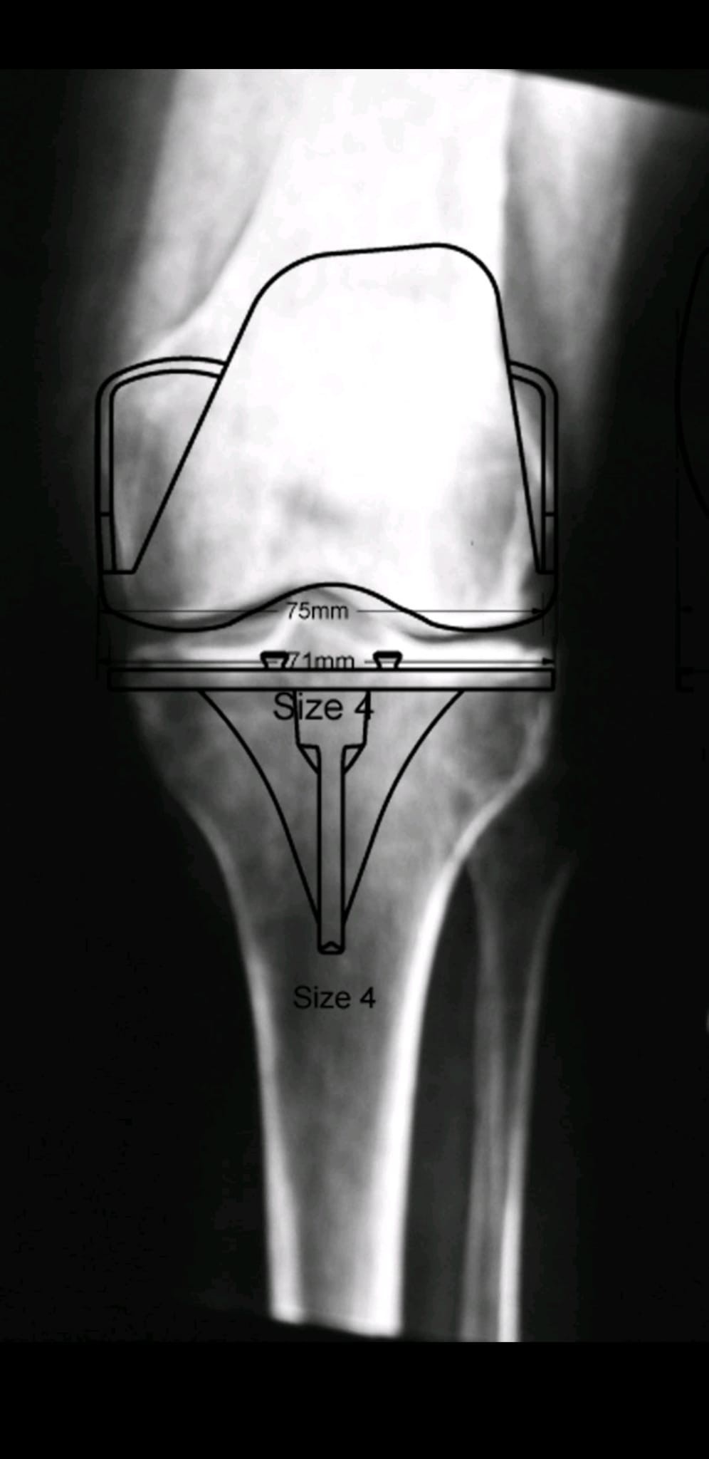 Prótesis total de rodilla